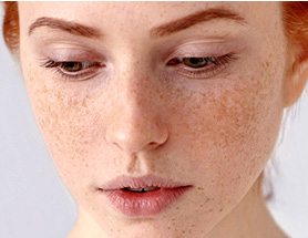 Aging Sun Damaged Skin Treatments | Jiva Med Spa - Columbus, OH