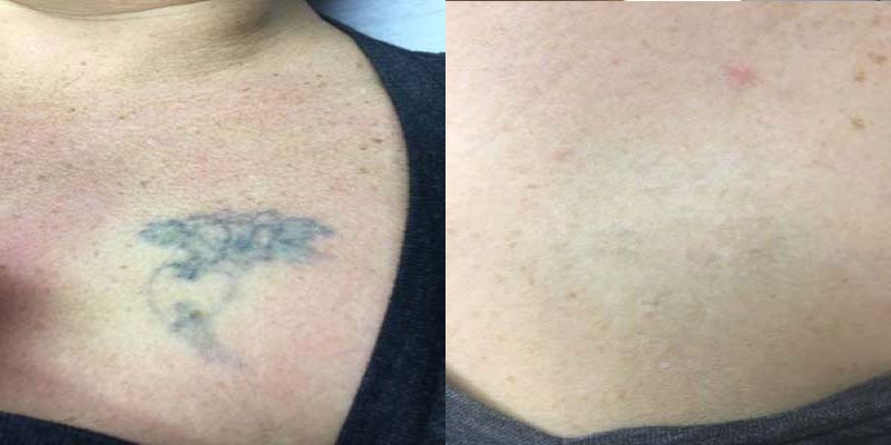Laser Tattoo Removal In Columbus, Dayton, Cincinnati Ohio