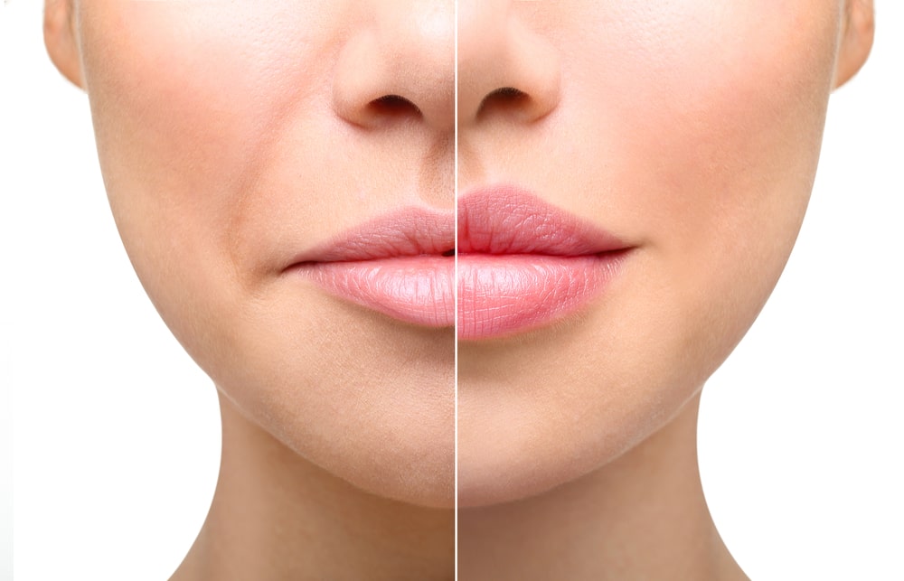 Everything You Need to Know About Lip Fillers