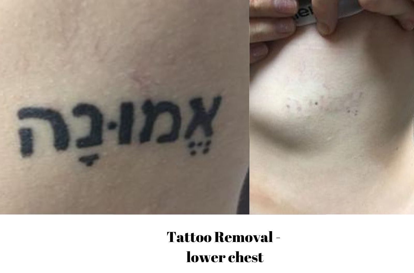 Laser Tattoo Removal - Dayton Skin Care