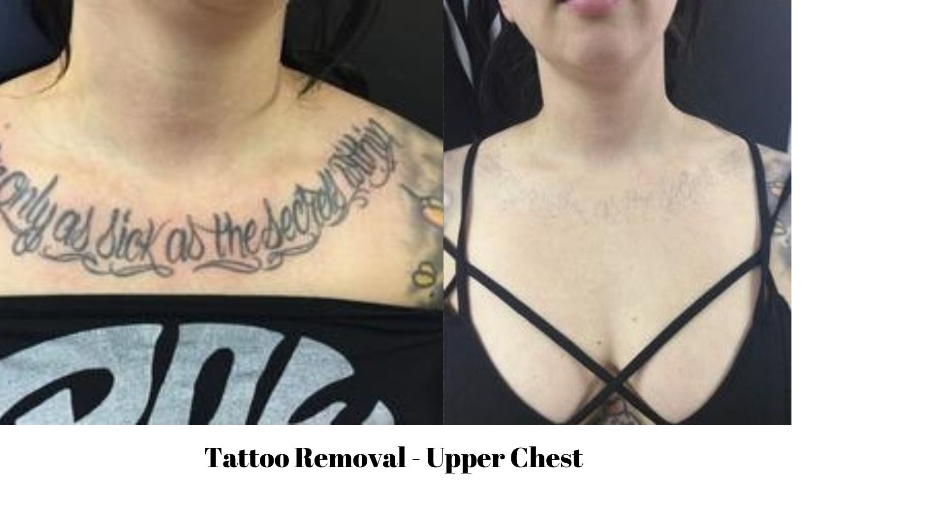 How Much Does It Cost to Remove a Tattoo?