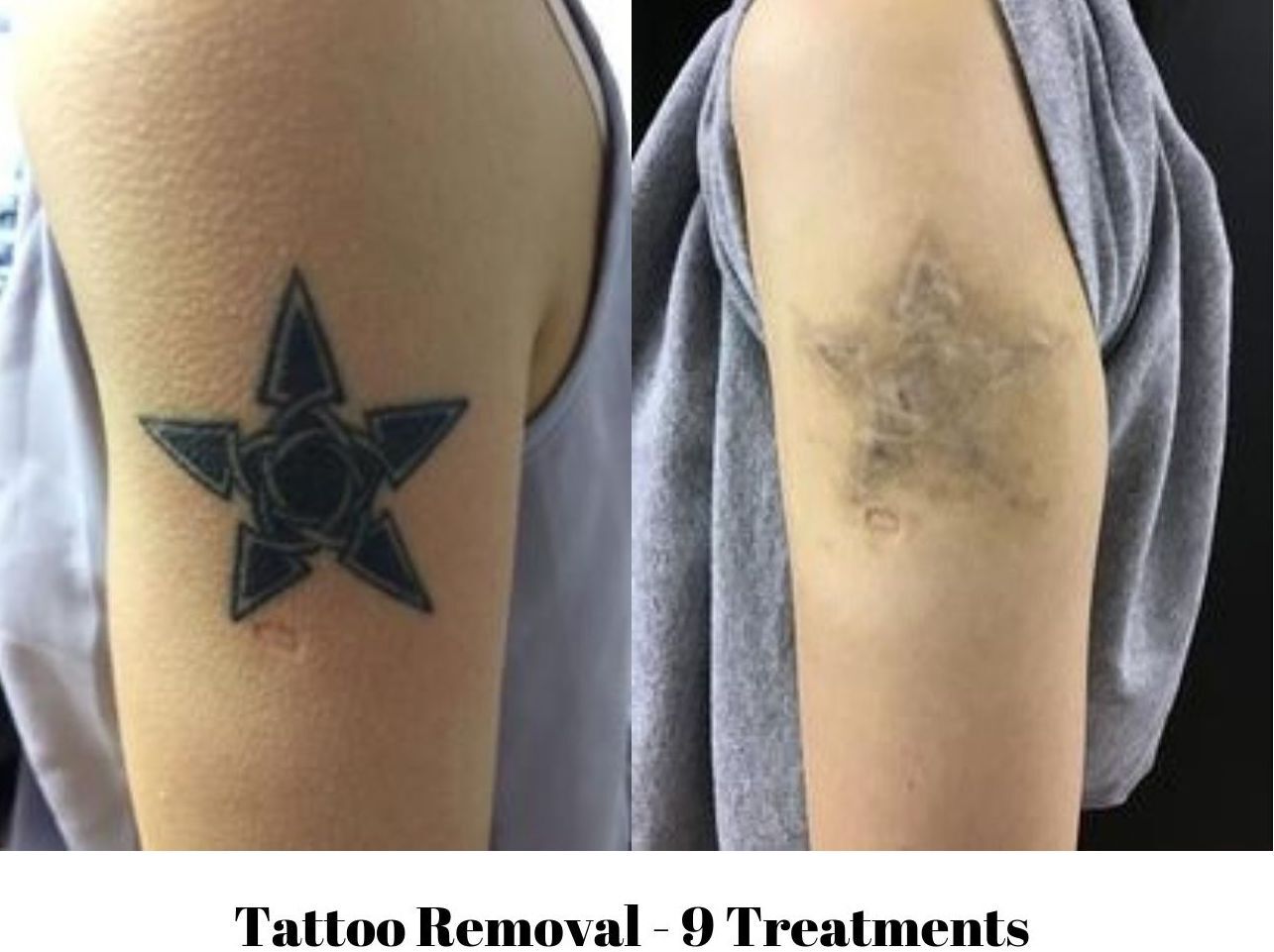 Tattoo removal using lasers means no scars but process still isnt easy   clevelandcom