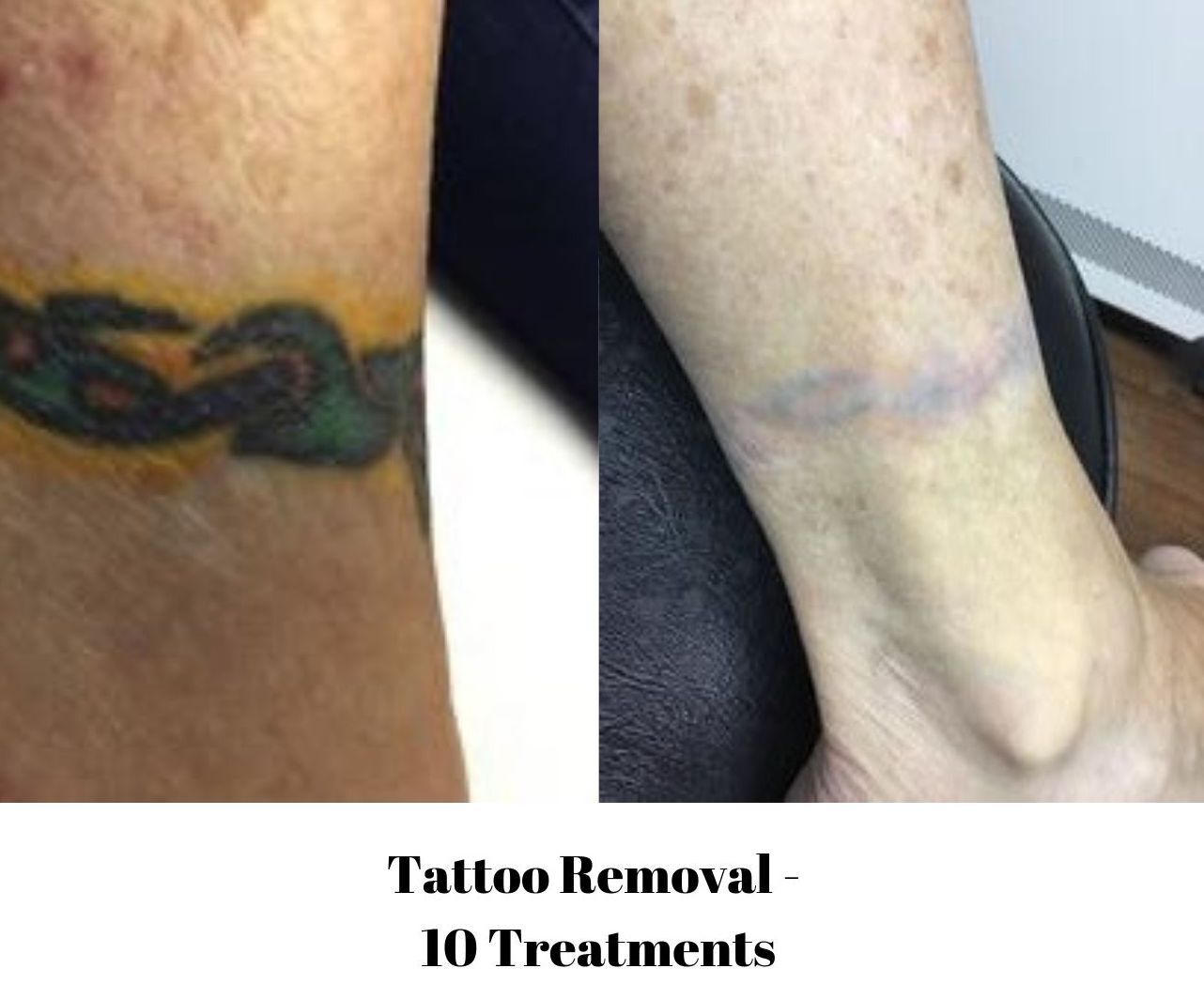 Athens, GA Tattoo Removal - Yuva Medical Spa