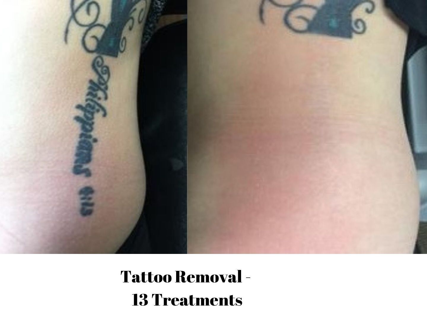 Tattoo Removal Before and After  Tattoo removal Tattoo removal results  Full tattoo