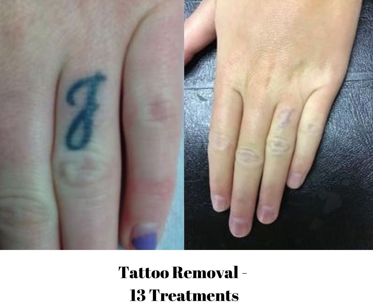 TOP 10 BEST Free Tattoo Removal in Los Angeles, CA - Updated 2024 - Yelp