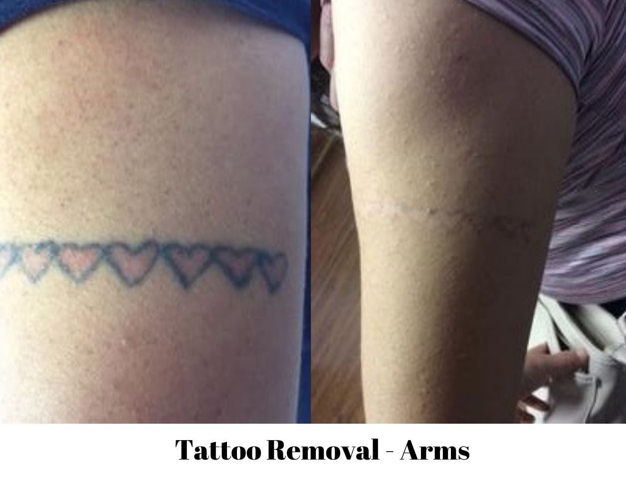 NonLaser Tattoo Removal in CharlestonHuntington Tatt2Away