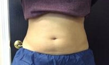 Picture of patient's untreated stomach area after CoolSculpting prodecure.