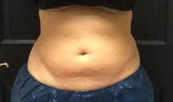 Picture of patient's untreated stomach area prior to CoolSculpting prodecure.