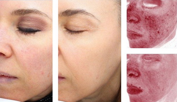 CO2 Laser Skin Resurfacing  Dr Monica Scheel Dermatology, Kailua-Kona, HI
