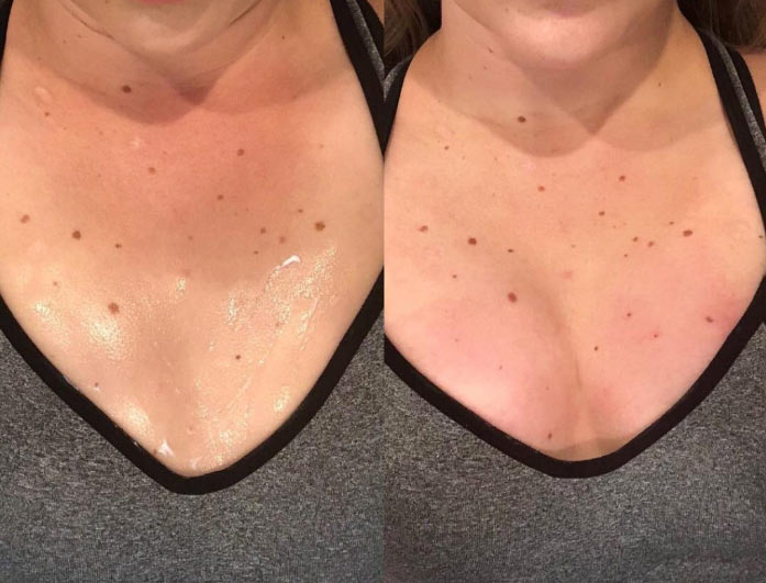 The Vampire Breast Lift Procedure in Ohio | Great Skin Ohio