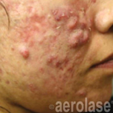 Aerolase Laser