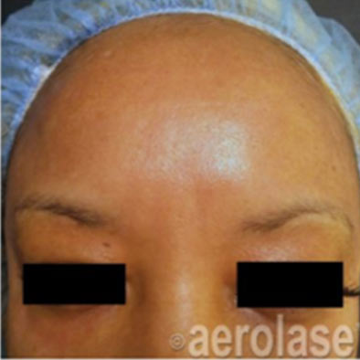 Aerolase Laser