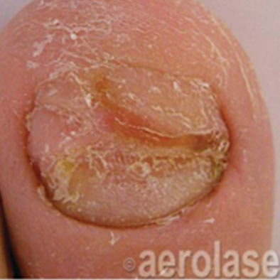 Aerolase Laser