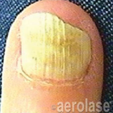 Aerolase Laser