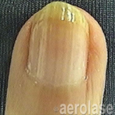 Aerolase Laser