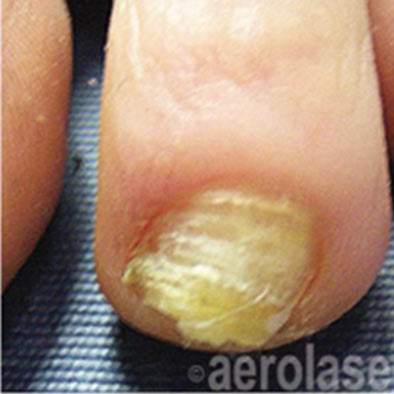 Aerolase Laser