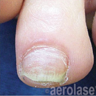 Aerolase Laser