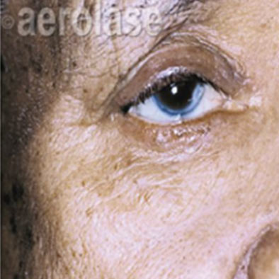 Aerolase Laser