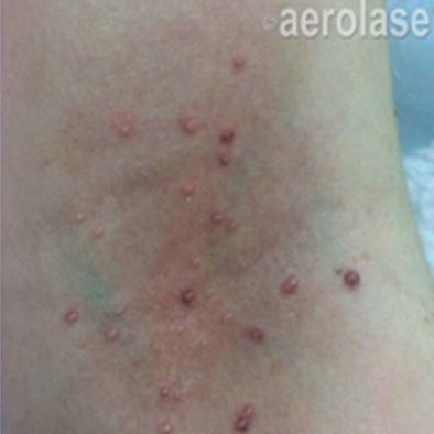 Aerolase Laser