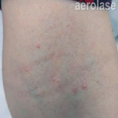 Aerolase Laser