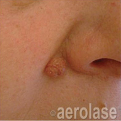 Aerolase Laser