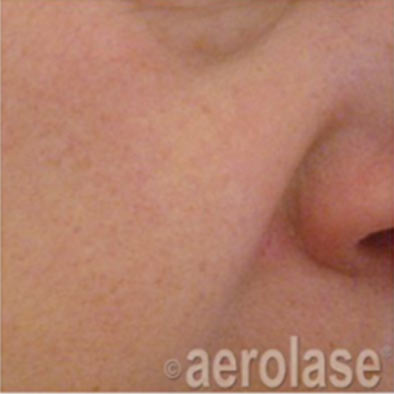 Aerolase Laser