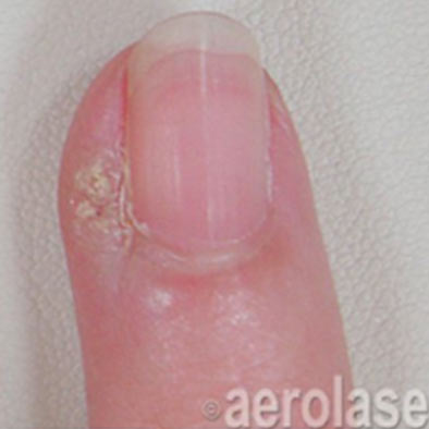 Aerolase Laser