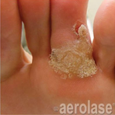 Aerolase Laser