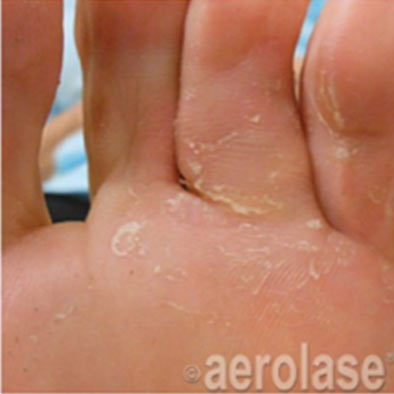 Aerolase Laser