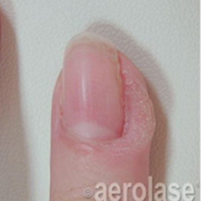 Aerolase Laser