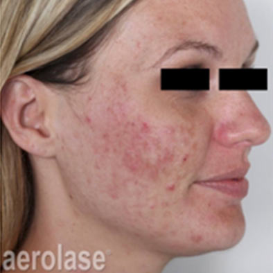 Aerolase Laser