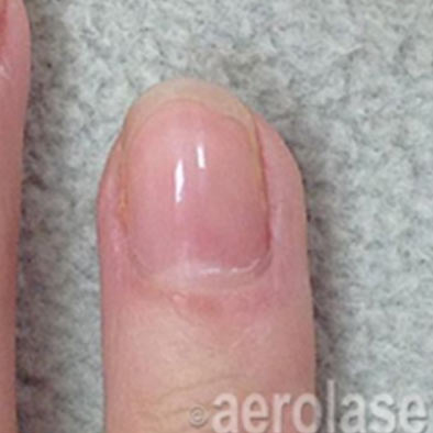 Aerolase Laser