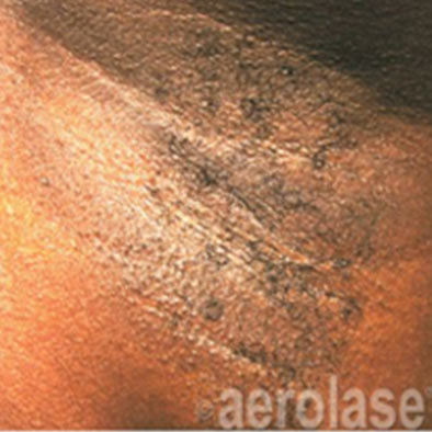 Aerolase Laser