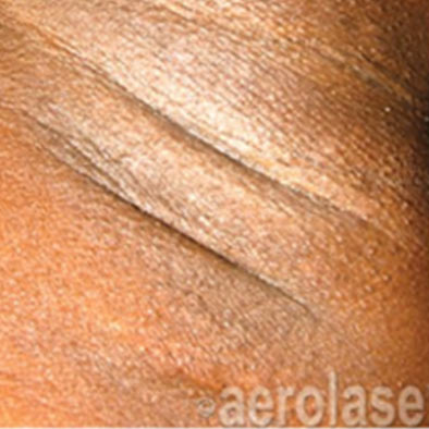 Aerolase Laser