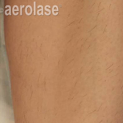 Aerolase Laser