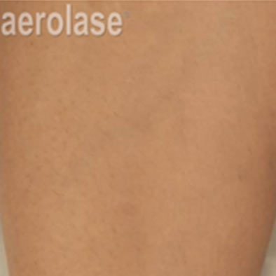 Aerolase Laser