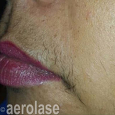 Aerolase Laser