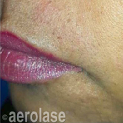Aerolase Laser