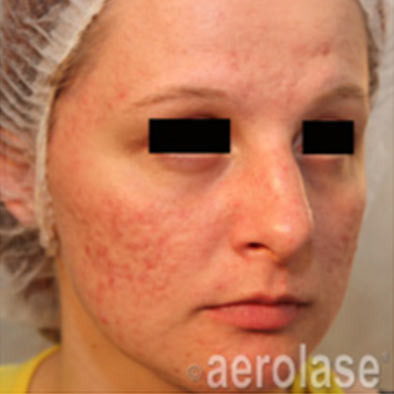 Aerolase Laser