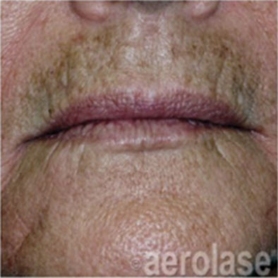 Aerolase Laser