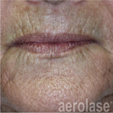 Aerolase Laser