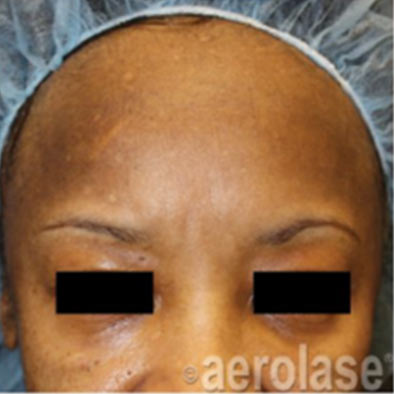 Aerolase Laser