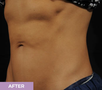 After Accufit Procedure