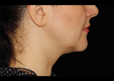After CoolSculpting: Double Chin
