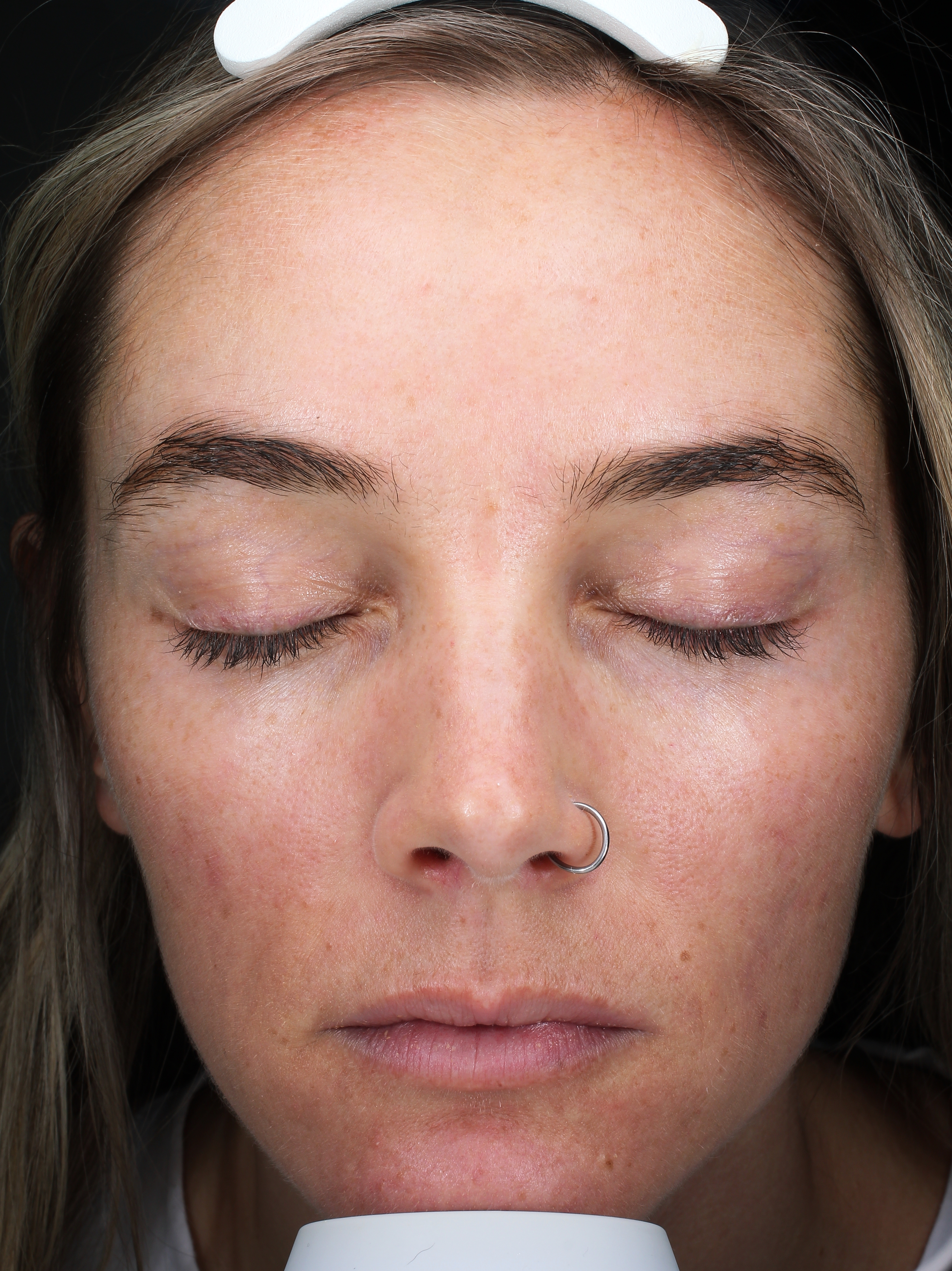 Front Face View After Acne Treatment