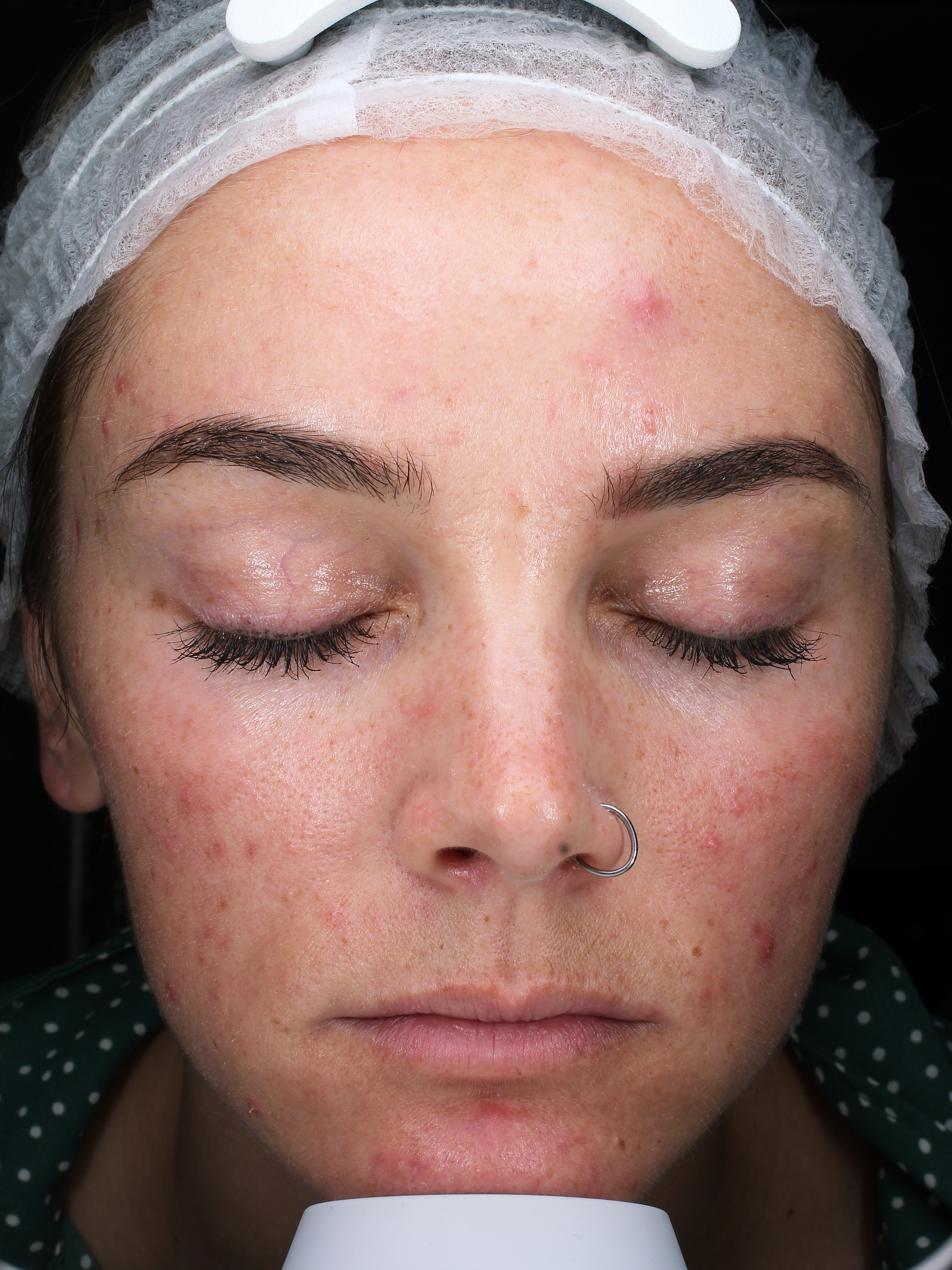 Front Face View Before Acne Treatment