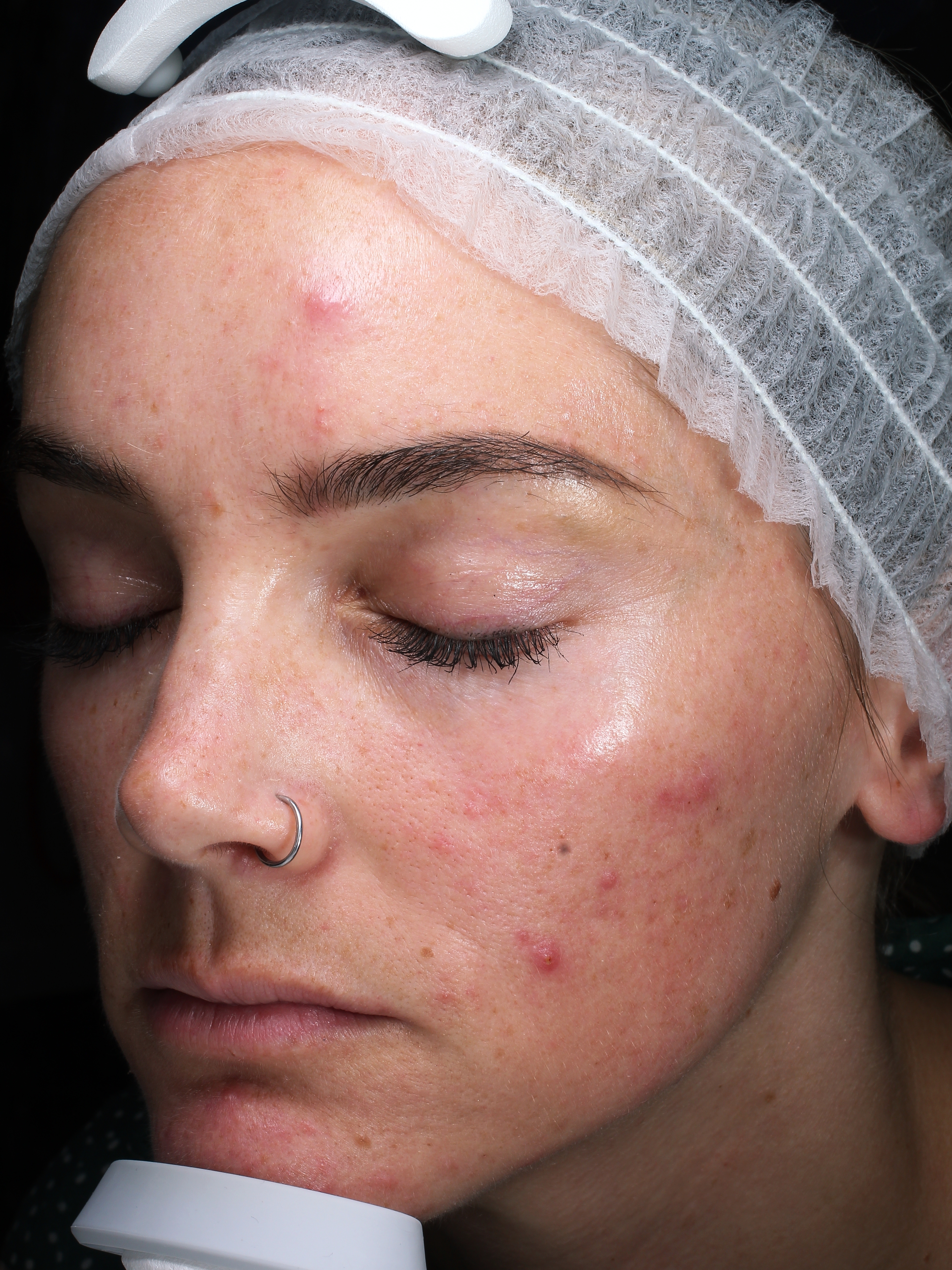 Left Face View Before Acne Treatment