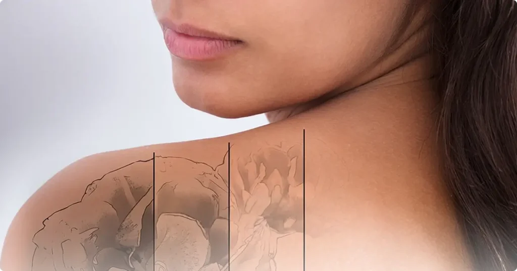 tattoo-removal-at-jiva-featured-image